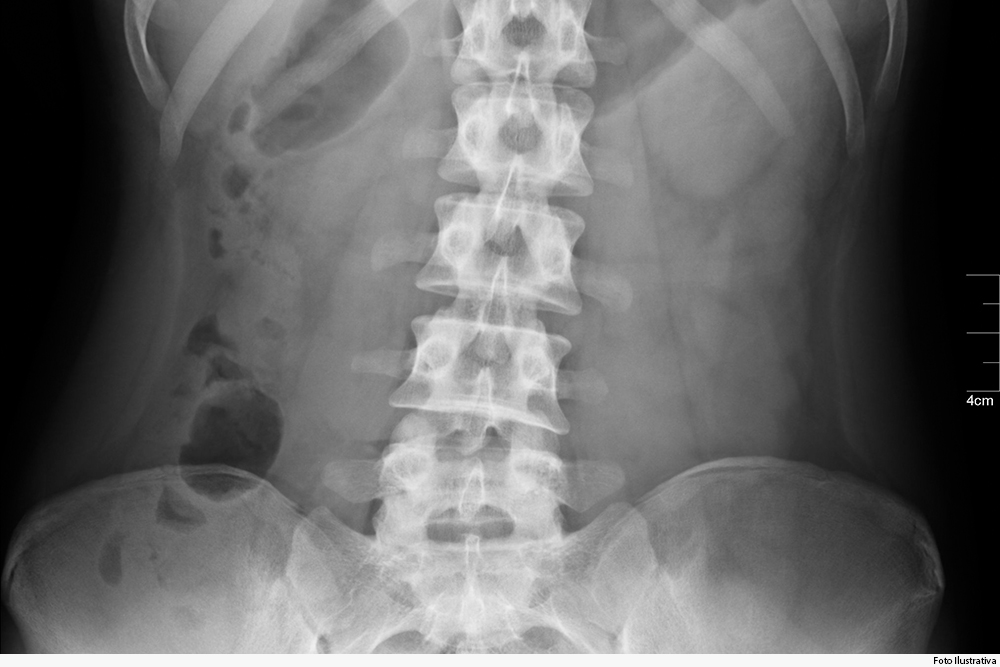 noticia-raio-x-coluna-vertebral-04.05.jpg